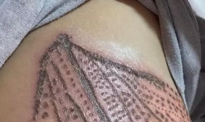 Maquiadora sofre queimaduras graves em seio após procedimento estético