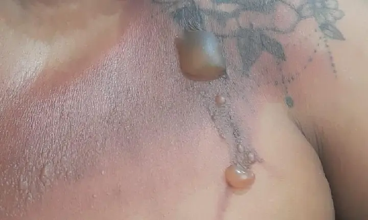 Mulher é queimada pelo próprio companheiro em Parauapebas