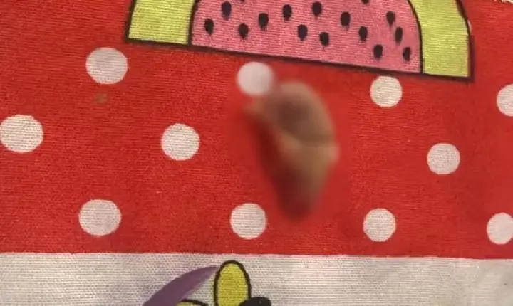 Mulher tem parte da orelha arrancada após ser mordida pelo companheiro em Tailândia