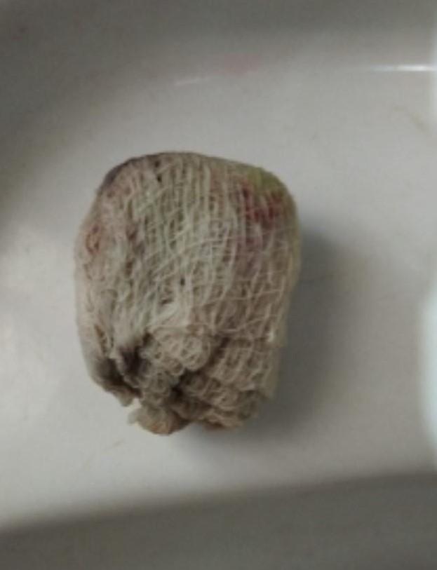 Canaã dos Carajás: mulher denuncia gaze esquecida em genitália após parto