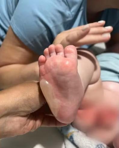 Bebê fica ferido após queimaduras durante banho em berçário de creche