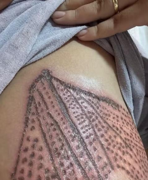 Maquiadora sofre queimaduras graves em seio após procedimento estético