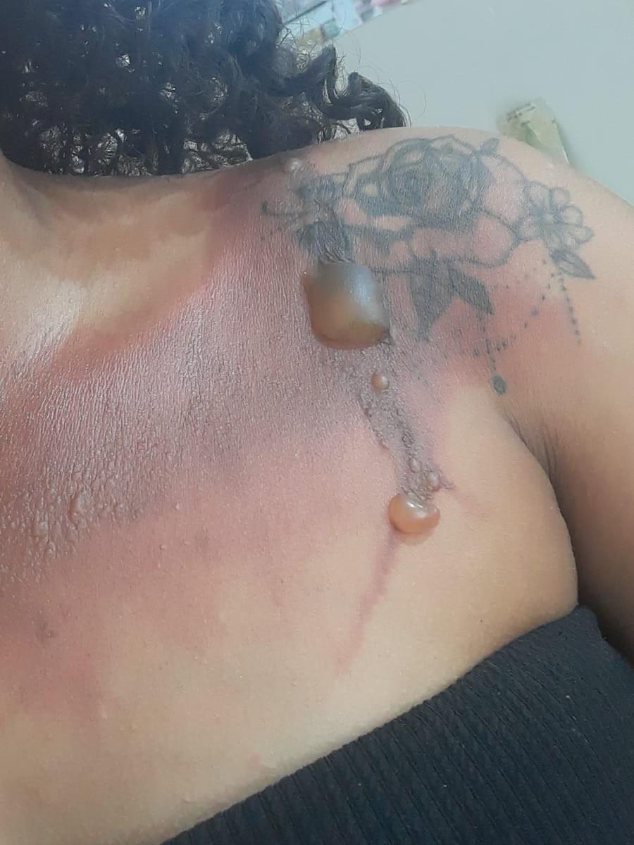 Mulher é queimada pelo próprio companheiro em Parauapebas