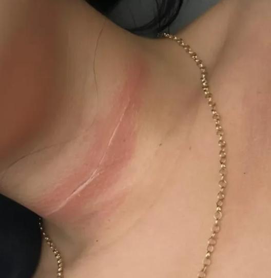 Adolescente fica ferida no pescoço após ser atingida por linha de pipa em Santa Inês (MA)