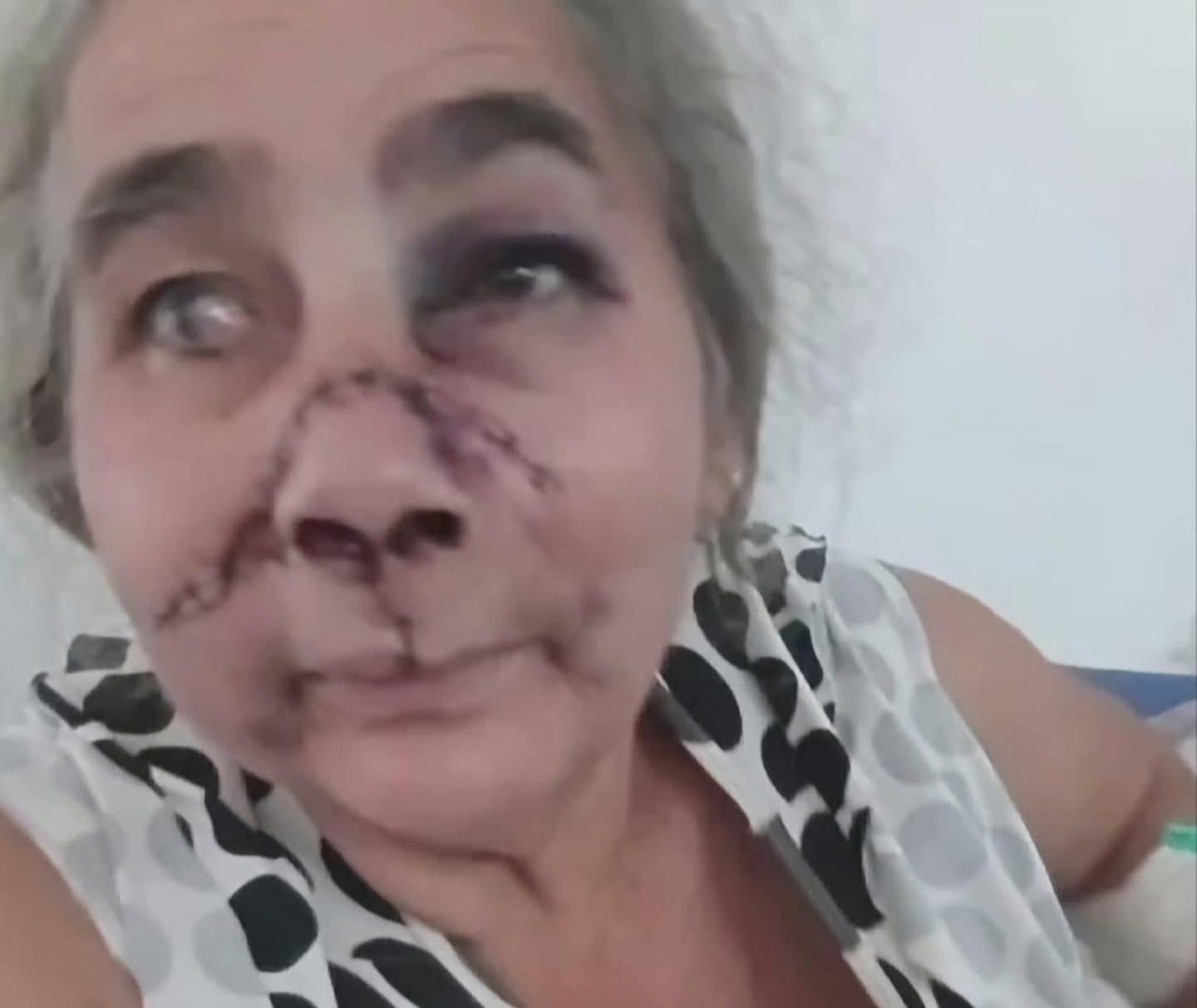 Filho agride a própria mãe e deixa rosto da vítima desfigurado em povoado de Codó