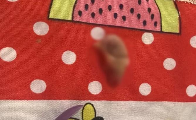 Mulher tem parte da orelha arrancada após ser mordida pelo companheiro em Tailândia