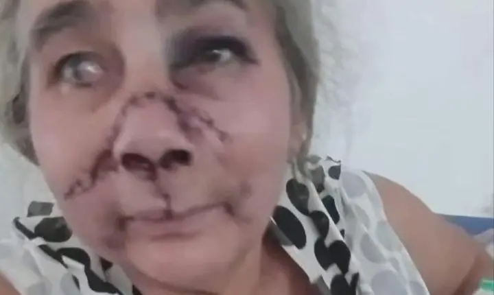 Filho agride a própria mãe e deixa rosto da vítima desfigurado em povoado de Codó